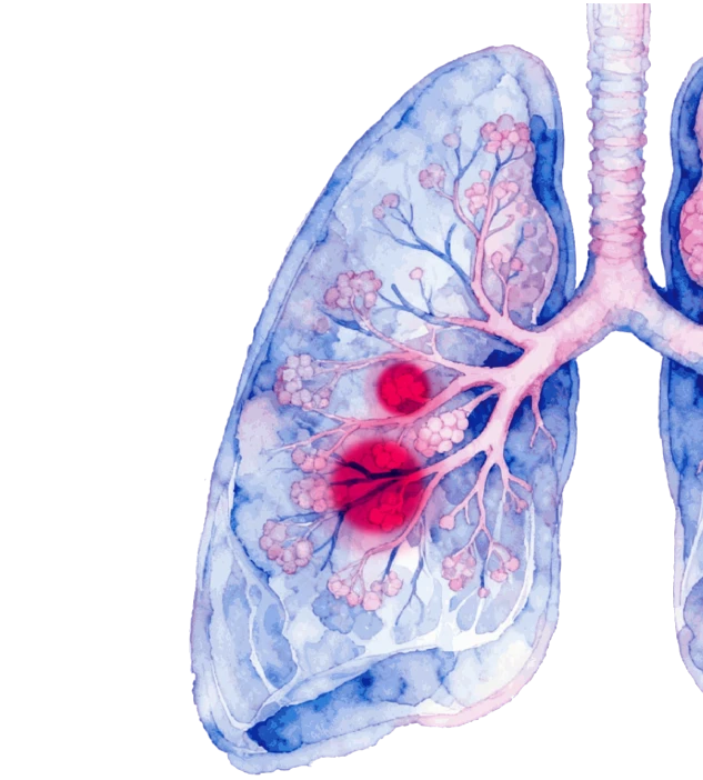 Non-small cell lung cancer