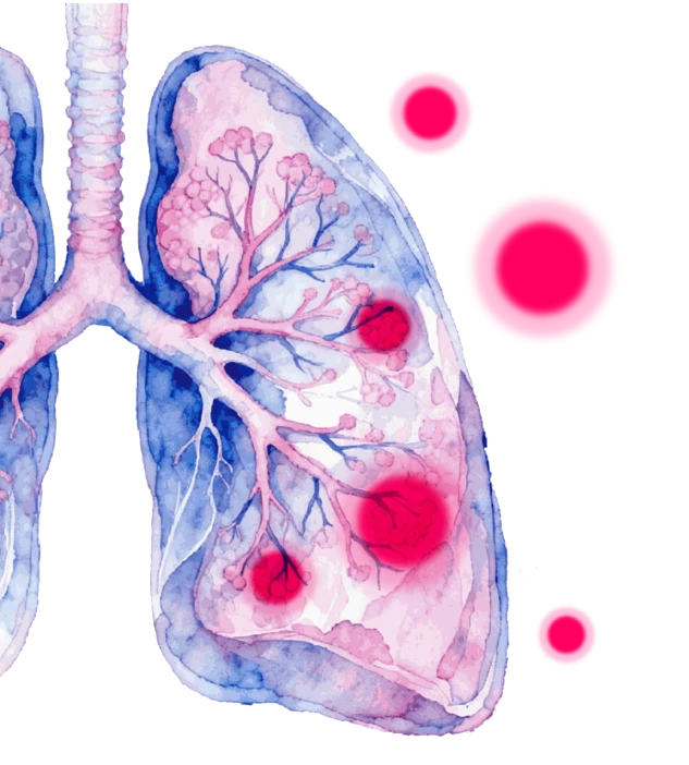Small-cell lung cancer